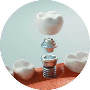 implant dentaire au CABINET DU NOUVEAU SOURIRE à Lambersart