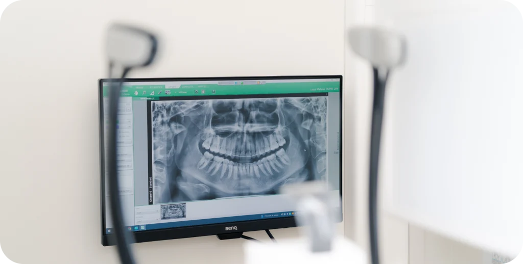 Consultation avant extraction des dents de sagesse à Lille dans un cabinet dentaire proche de Lambersart